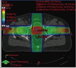 effective as in curing prostate cancer GPs can help ensure men know treatment options Advances in RT have significantly reduced serious side effects & improved the patient experience