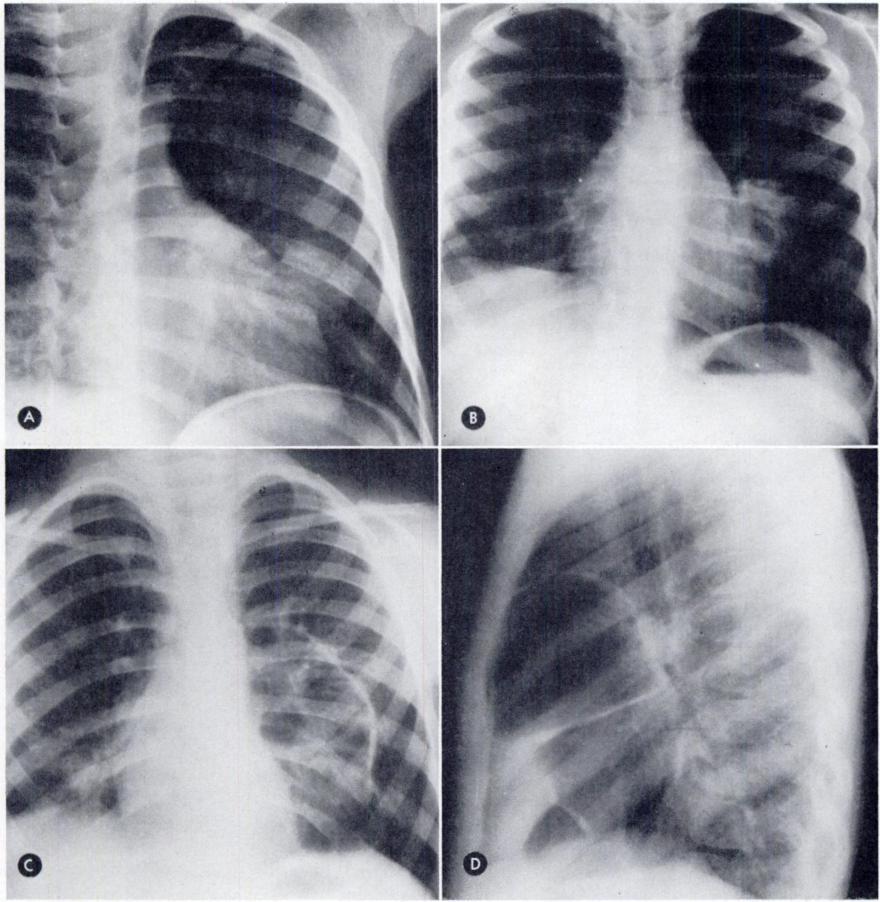 VOL. 126, No. Cavitating Lung Nodules 729 ( L FIG. I. Case,. (A) March 7. Twenty degree right anterior oblique proiection of the chest shows a metastatic nodule in the lingula. (B) April i8.