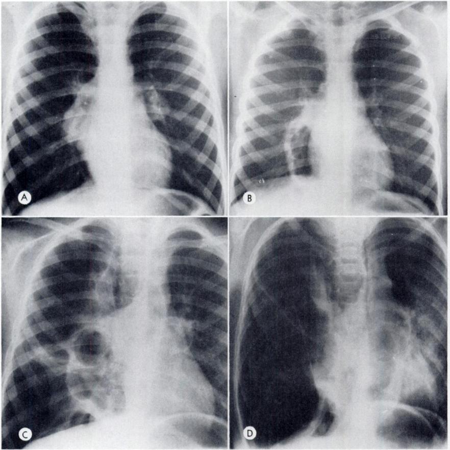 732 E. G. Kassnen, H. S. Goldman and A. Elguezabal APRIL, 1976 FIG. 3. Case u. (A) September 21. Metastatic deposits are present in the hilar lymph nodes and in the midzones of both lungs.