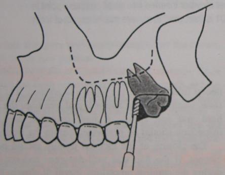 with a straight elevator with no resistance from the bone unlike the mandible which is very resistant and calcified.