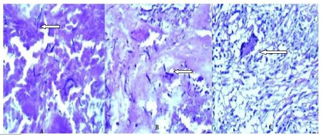 Fig-D Figure D: histopathological image shows:- - Necrotic tissue in the see blue-stained rod-shaped, segmented or branched fungal hyphae - Multinucleated giant cells DISCUSSION Fungal disease is a