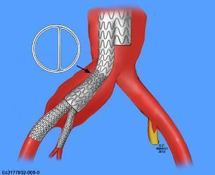 Parallel Stent-Grafts 40 pts/ 48 IIAs 100% technical success 0%