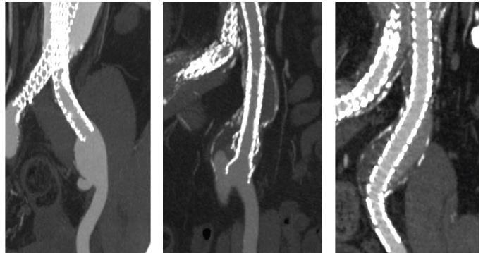 Long-Term Durability of Complete Aneurysm Sealing with Nellix in CIA METHODS: Outcomes were analyzed in three groups: A. Untreated common IAA (n=15) B. Partially excluded IAA (n=15) C.