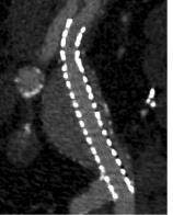 EVAS for Iliac Artery Aneurysm Excludes common iliac artery aneurysms with minimal distal neck Treats iliac artery
