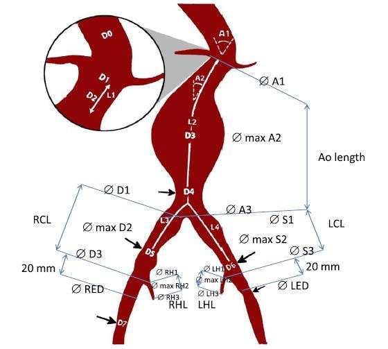 Iliac Branch Devices (IBDs) Limitations Complex Sizing and Case Planning Multiple Exclusion