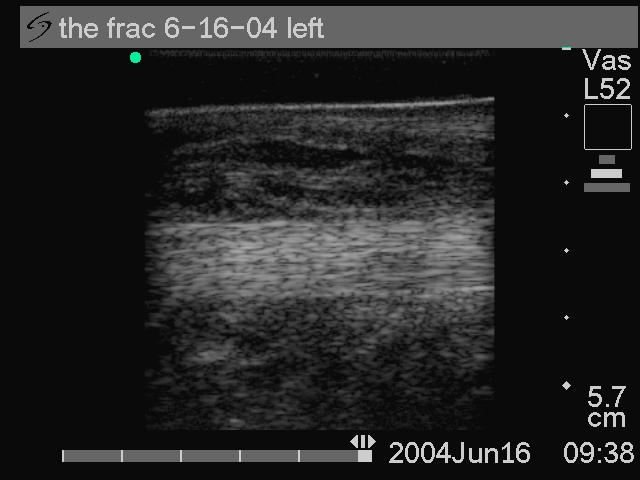 Short axis ultrasonography of the SDFTs
