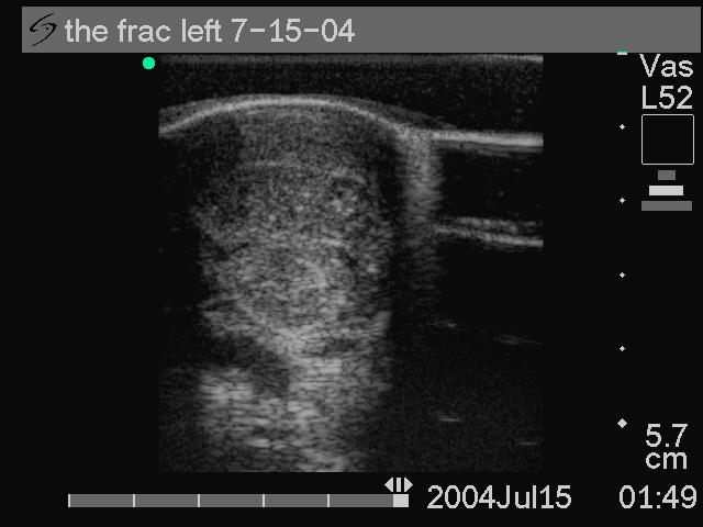 Second Follow-up Ultrasonographic Images and