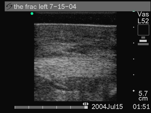 Short axis ultrasonography of the SDFTs 7-15-04