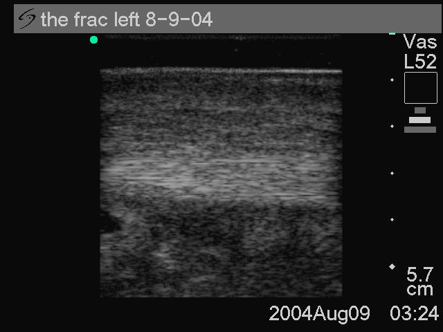 Clinical Evaluation Image 4:7. Long axis ultrasonography of the SDFTs 8-9-04 Image 4:6.