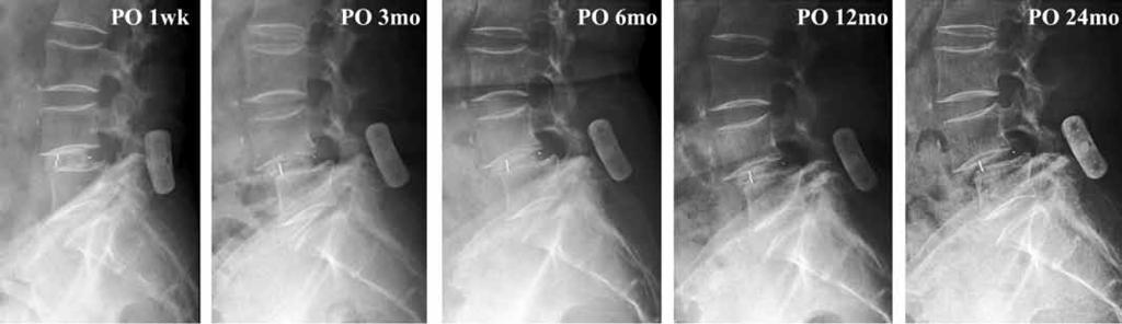 Figure 4: An illustrative case. A 75-year-old woman underwent unilateral PLIF using SPIRE. Spondylolisthesis and back pain were aggravated 3 months after the surgery.