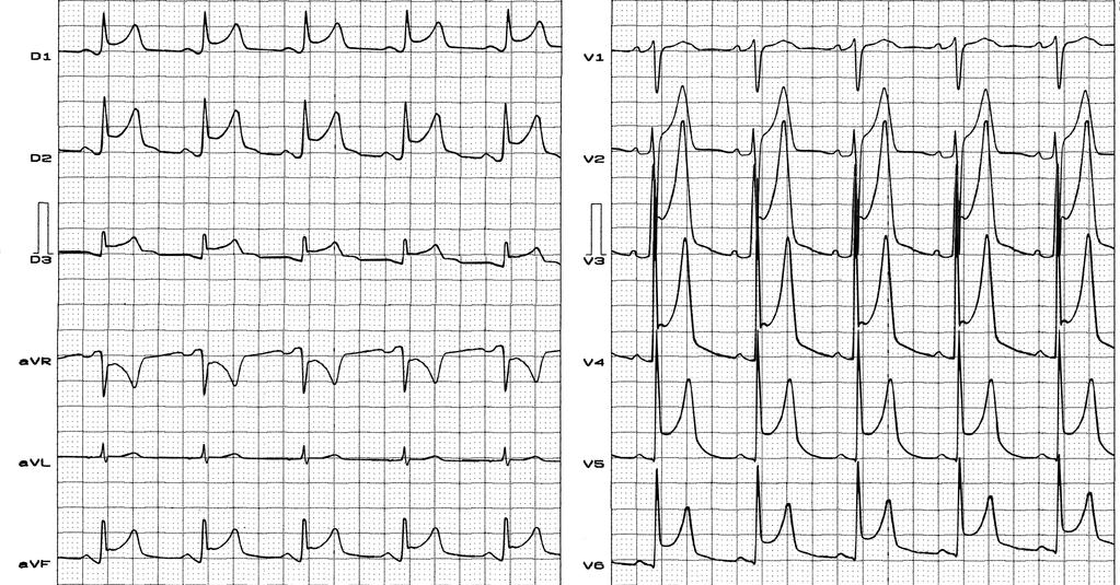 Typical ECG of acute pericarditis in the first phase with