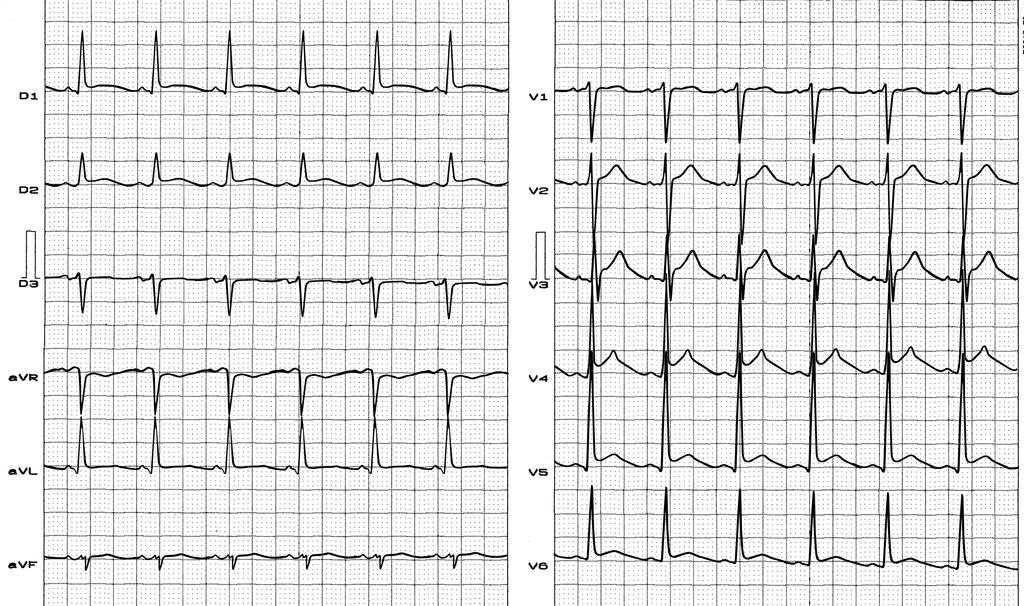 Male patient, 59 years old Complaint: chest pain, odontalgia for 1 week and fever Physical examination: inflammatory signs of right submandibular region, fever (39º), negative auscultation.