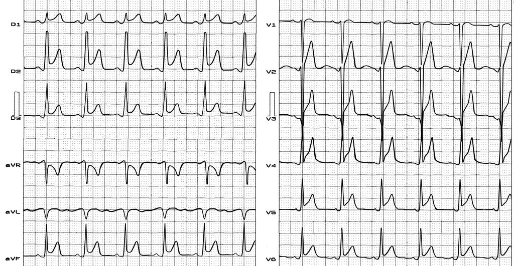 Acute pericarditis in phase 1 ST segment elevation with superior