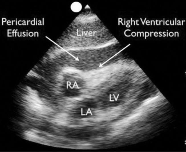 ECG in cardiac tamponade Massive pericardial Efussion Cardiac tamponade occurs when fluid accumulation in the finite serous pericardial space causes an increase in pressure, with subsequent cardiac