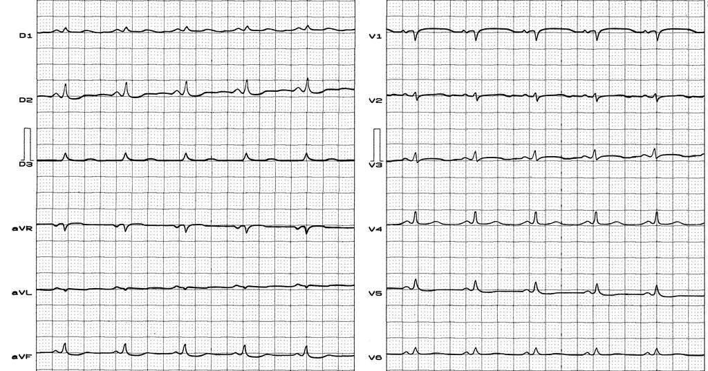 ECG Constrictive pericarditis Constrictive pericarditis, low voltage of QRS complexes in all leads (this