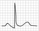 First phase: Frequent sinus tachycardia in acute pericarditis due to pain and/or pericardial effusion. Widespread concave ST segment elevation (<5 mm) of superior concavity.