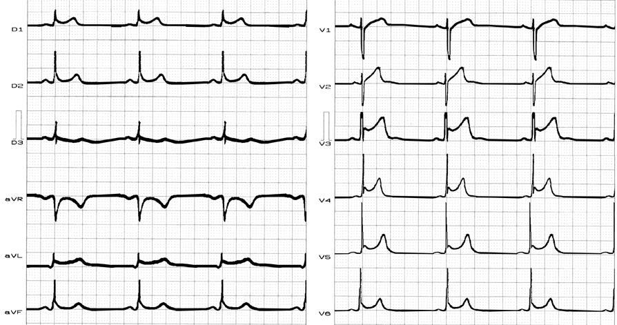 Differential diagnosis between acute pericarditis and early repolarization Sinus bradycardia, upwardly concave ST segment