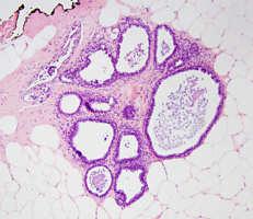 Columnar cell lesions-- Histologic features Columnar cell