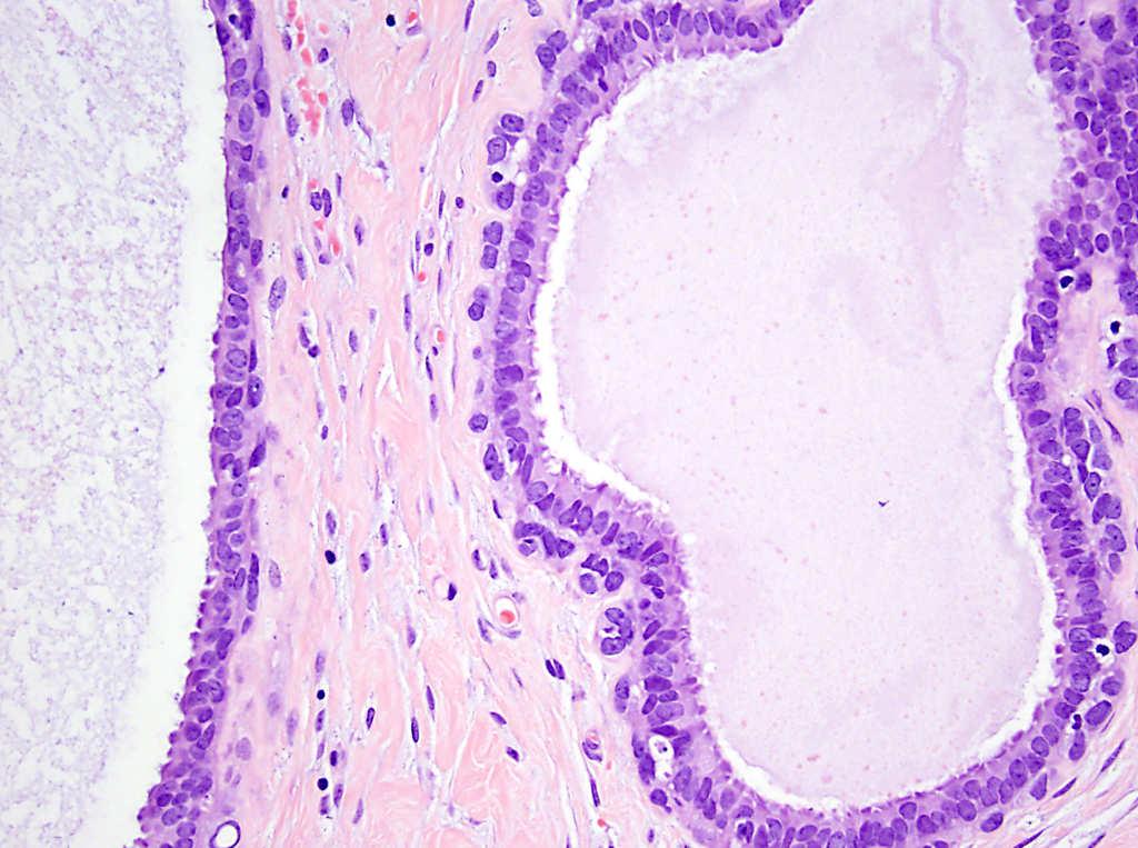 Columnar cell change Columnar cell hyperplasia Flat epithelial atypia--
