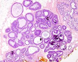 Flat epithelial atypia-- Histologic features