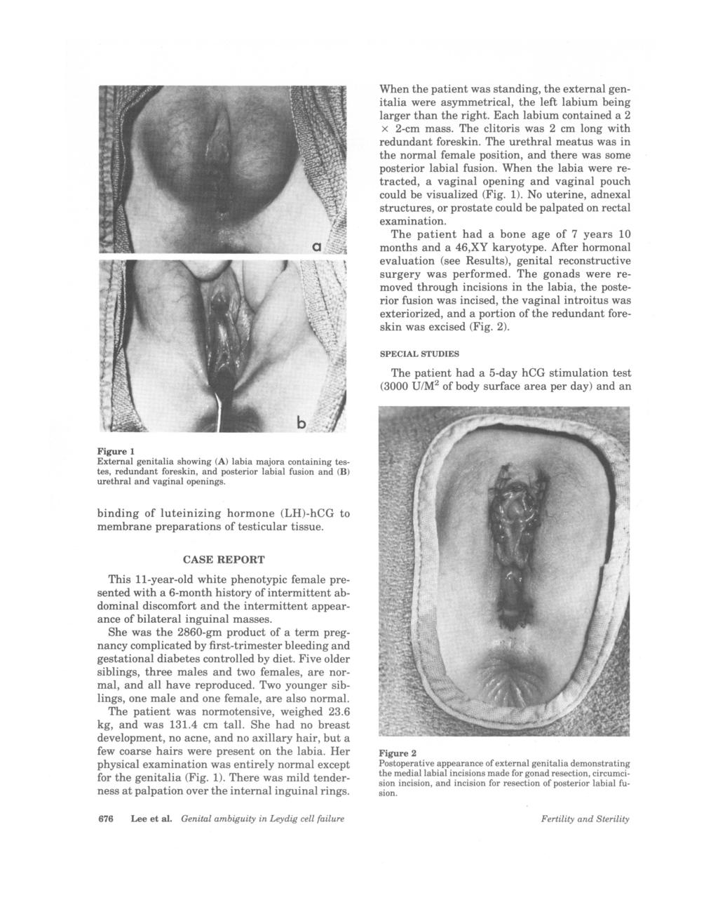 When the patient was standing, the external genitalia were asymmetrical, the left labium being larger than the right. Each labium contained a 2 x 2-cm mass.