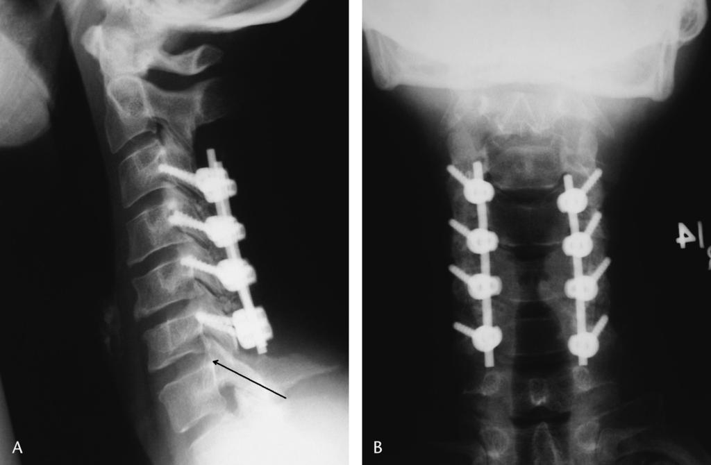 JOBNAME: jsd 00#0 2005 PAGE: 2 OUTPUT: Tuesday April 26 17:14:08 2005 Sekhon J Spinal Disord Tech Volume 00, Number 0, Month 2005 F1 with digital fluoroscopic guidance.
