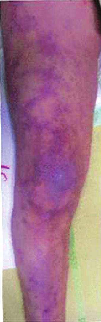 score 3, mild mottling area that does not exceed the middle thigh; score 4, severe mottling area that does not exceed the fold of the groin; score 5, extremely severe mottling area that exceeds the