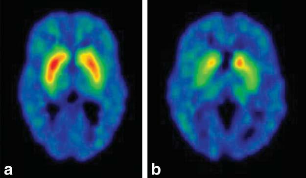 Imaging: DaTSCAN (a) healthy age-matched control subject (b) asymptomatic carrier of a