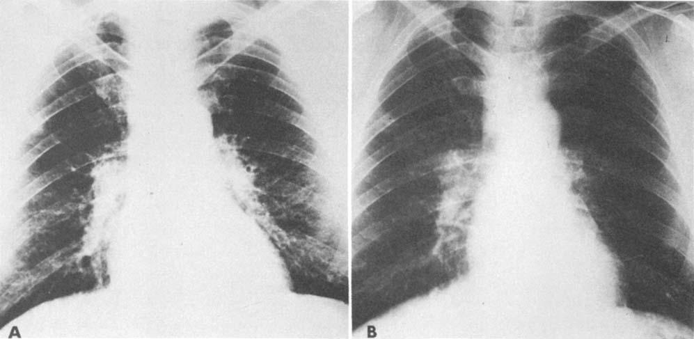 FAULKNER, ADKINS, AND REYNOLDS FIG. 2. (Patient 3.) (A) Admission chest roentgenogram demonstrates a small right upper lobe coin lesion and bilateral infiltrates.