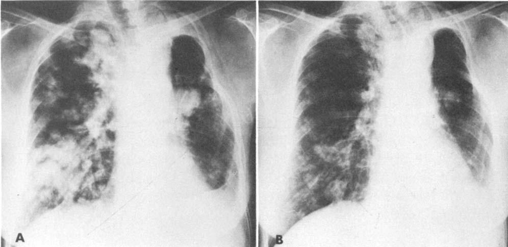 After 5-FU was started, her chronic cough disappeared and the pulmonary nodules decreased in size by approximately 50% (Fig. 3B).