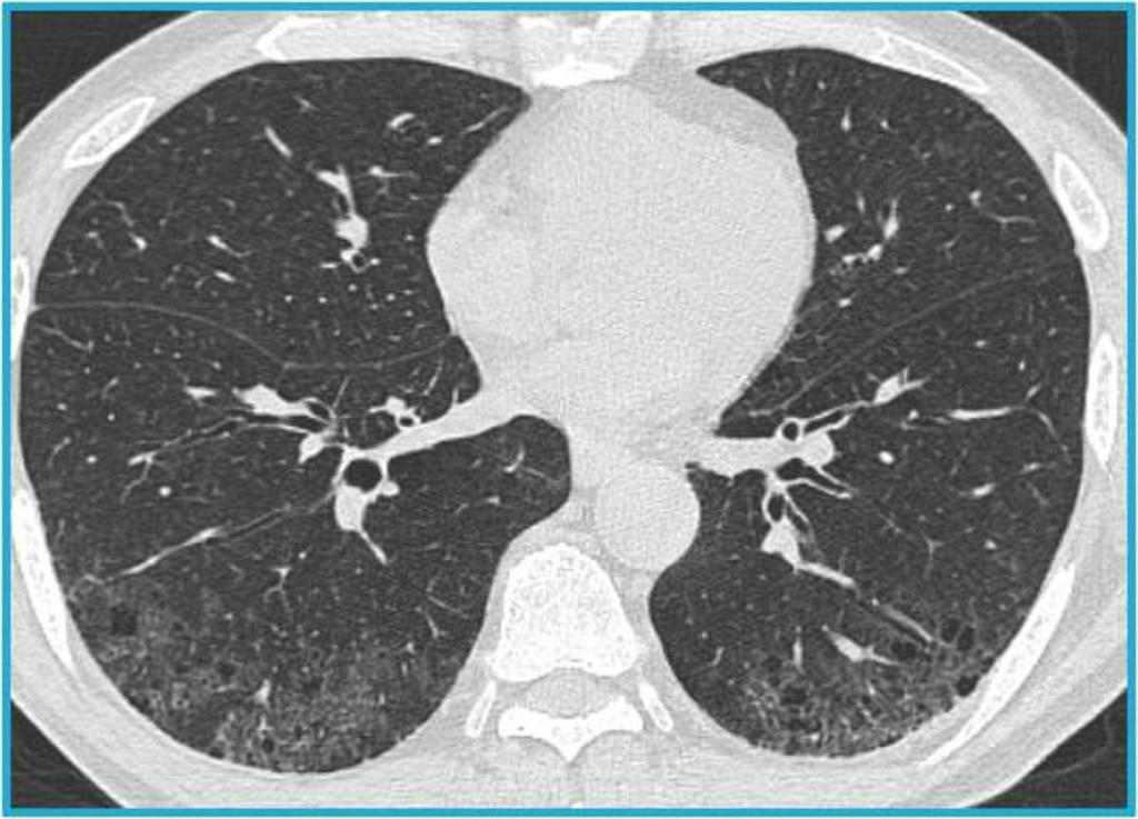 Fig. 4: Early DIP in a 70-year-old smoker. Areas of GGO are present with basal predominence.