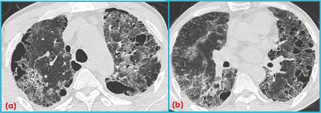 5: A 62-year-old man who has desquamative interstitial pneumonia.