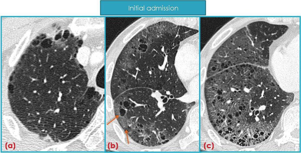 Fig. 6: DIP and emphysema in a 65-year-old heavy smoker who presented with