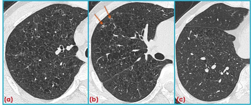 Fig. 7: Follow up images of patient in Figure 6. (d-e) HRCT obtained after 3 years show a marked increase in GGO and reticulation.