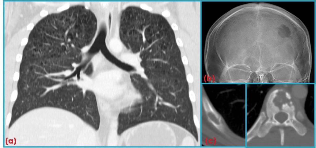 8: PLCH in a 49-year-old woman with a 60 pack-year history of smoking (a-c) HRCT images show bilateral irregular morphology of cysts in an upper lung predominance.