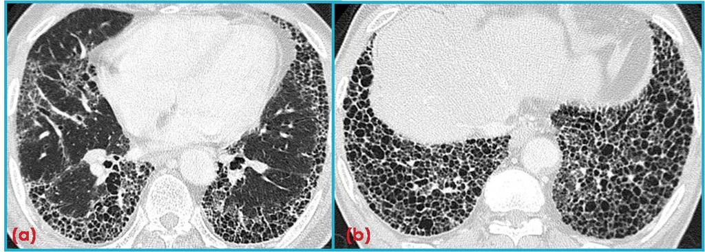 11: Advanced IPF in a 64-year-old former smoker with exertional dyspnea for an year.