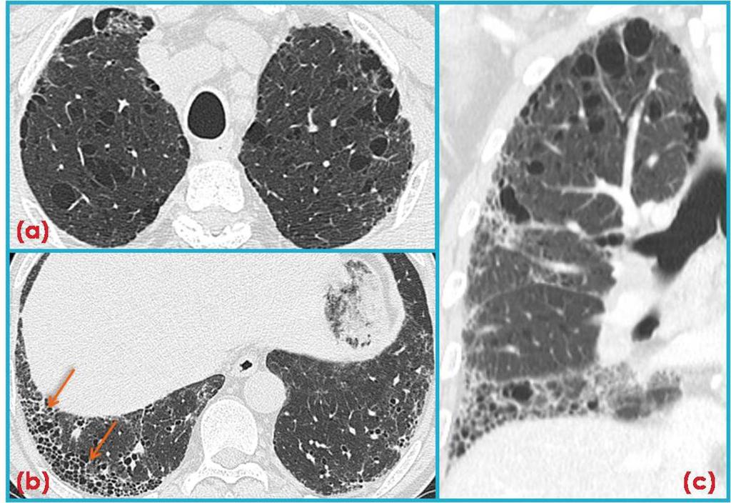 Fig. 12: CPFE in a 65-year-old male smoker with chronic cough. (a) HRCT image obtained through the upper lungs shows paraseptal and centrilobular emphysema.