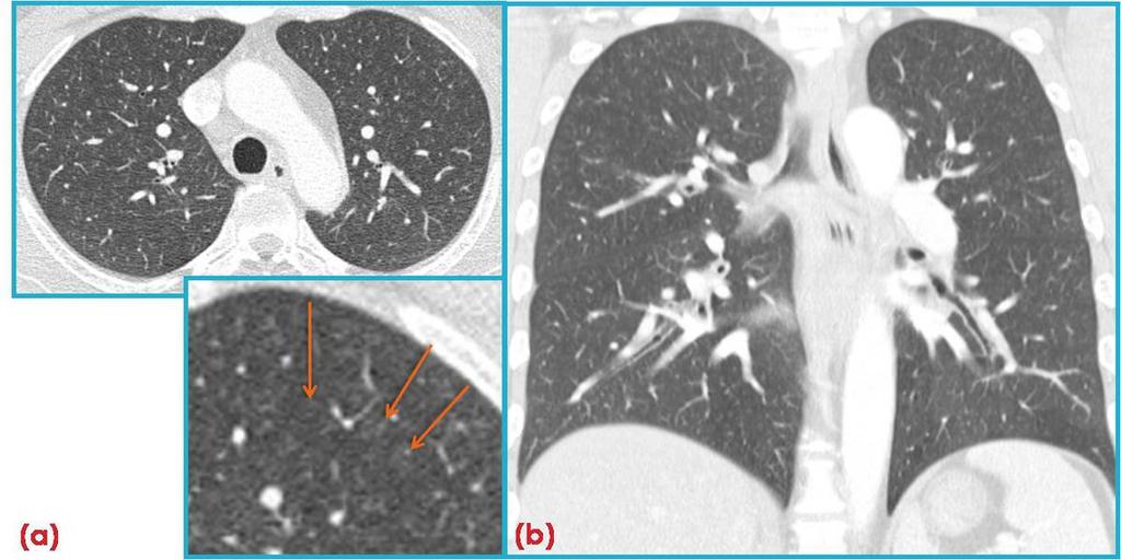 Images for this section: Fig. 1: RB in a 35-year-old man with a 10 pack-year history of smoking who had no respiratory symptoms.