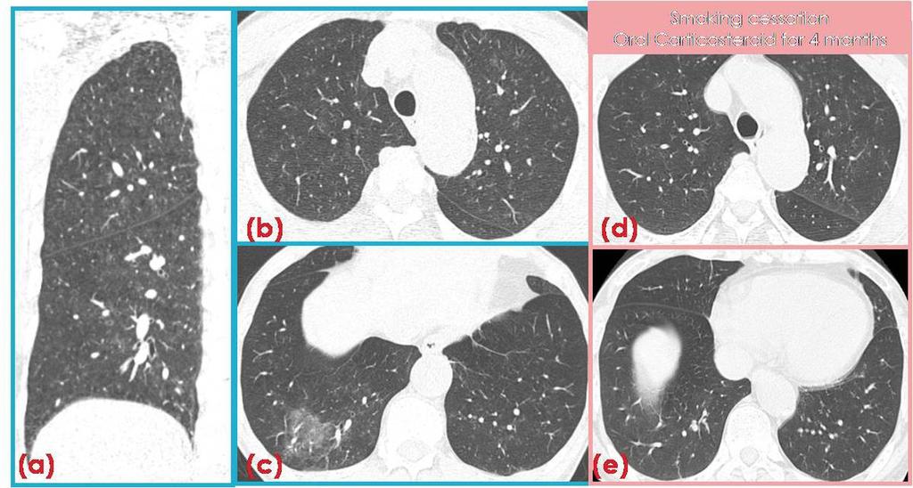 HRCT image with coronal reformatted image (b) shows centrinodular GGOs predominantly distributed in both upper lung. Fig.