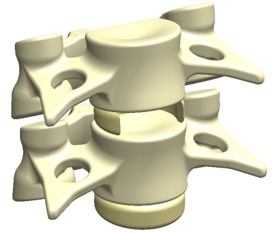 Apache Cervical Interbody Fusion Device Surgical Technique 1. Prepare disc and endplates Remove the disc of the appropriate level(s) through the window.