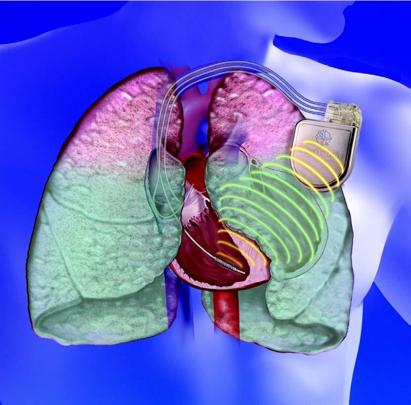 OPTIVOL Software Pulmonary Vascular Congestion Decrease in Intrathoracic