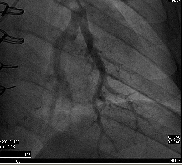 Pulmonary Artery Pressure Sensor RHC with