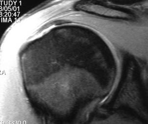 biceps lesions AC joint dislocations rotator cuff lesions MRI FINDINGS SUPRASPINATUS IN OVERHEAD