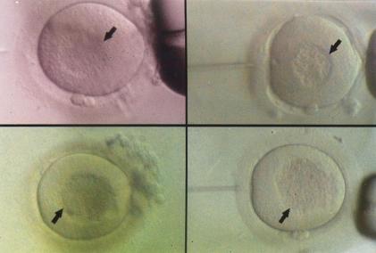 S.Kahraman et al. mosaicism or Y chromosome deletion/insertion. From February 1999, Y chromosome deletions are performed in our Molecular Genetic Laboratory. Figure 1.