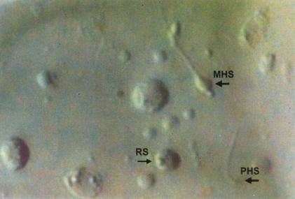 A megalohead spermatozoon (MHS) (big arrow) together with pin-head spermatozoon (PHS) (small arrow) and round spermatid (RS). Figure 3. Trisomy 13.