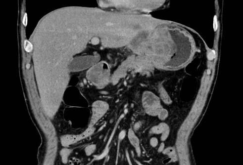 NAKAZAWA MUCOSAL ESOPHAGEAL SQUAMOUS CELL CARCINOMA WITH IGM Fig. 2 A coronal CT slice revealed a gastric tumor directly invading the left lateral segment of the liver and the body of the pancreas.