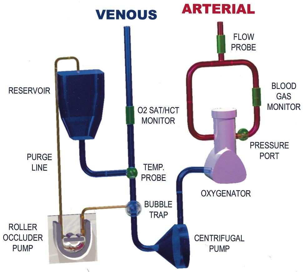 Ann Thorac Surg OJITO ET AL 2001;71:1267 72 ASSISTED VENOUS BYPASS 1269 negative 60 mm Hg for the assisted system. Almost all patients were cannulated with bicaval venous cannulas.