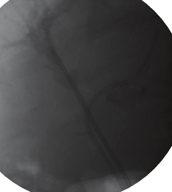 Figure 4: Application of radiofrequency ablation at the level of the right hepatic duct. Number of strictures treated 25 Mean stricture length (mm) 15.2 (SD = 8.7, range = 3.