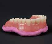 If the denture does not seat form-fitted on the mucosa of the patient s jaw, it is necessary to mold the patient s mucosal situation using