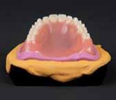 Use the denture like an impression tray and prepare an impression of the current mucosal situation using silicon lining material. 2.3.